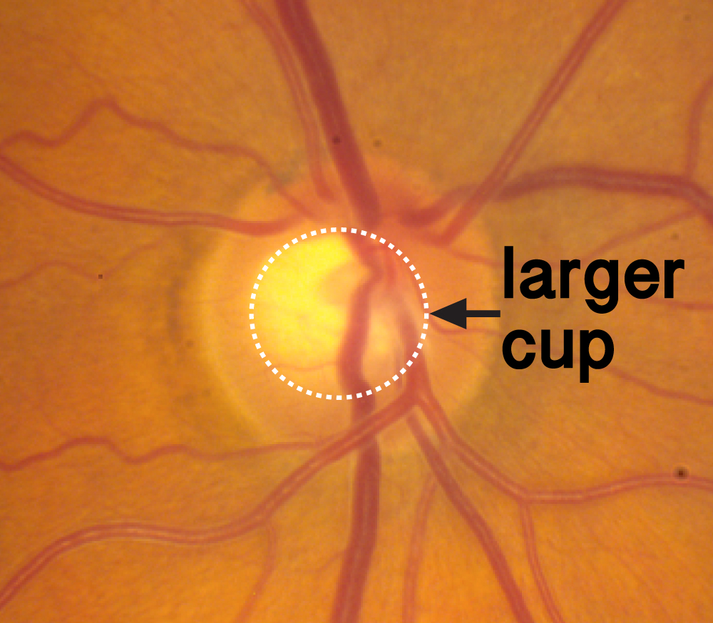normal optic nerve
